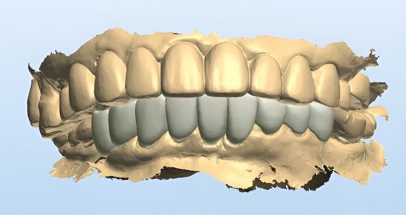 下顎前牙區數位牙科設計圖，模擬最終全瓷貼片排列與形狀