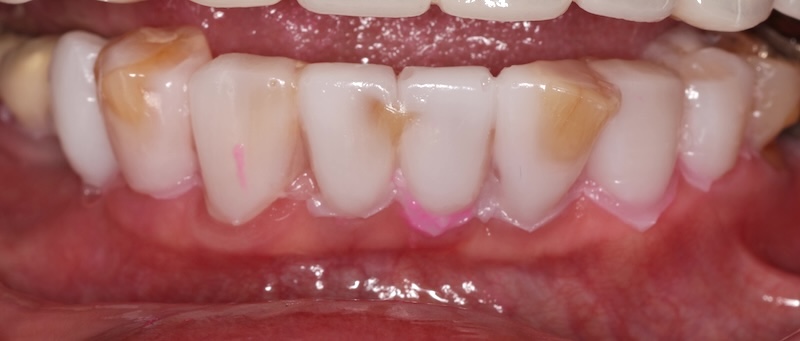 下顎前牙區進行樹脂試戴，顯示牙齒原始位置較突出，顏色較深之處需較多修磨量