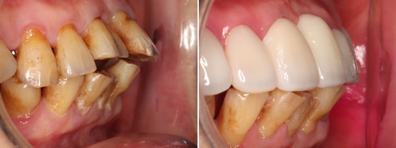 右側上顎全瓷假牙與貼片修復前後的口內對比照