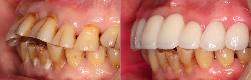 左側上顎全瓷假牙與貼片修復前後的口內對比照