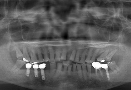 嚴重牙周病非手術治療推薦: 水雷射/全鋯冠牙橋/瓷牙貼片