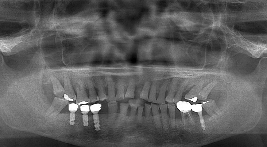 嚴重牙周病非手術治療推薦: 水雷射/全鋯冠牙橋/瓷牙貼片