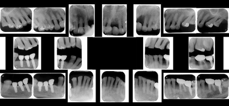 嚴重牙周病治療前的全口局部X光片