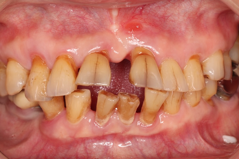 嚴重牙周病導致多顆牙齒突出、搖晃且牙縫變大，明顯影響咬合與美觀