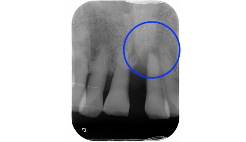 左上正中門齒的局部X光片，顯示牙周破壞已經到根尖處