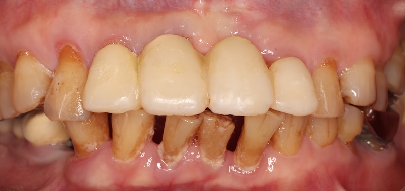 牙周治療前已拔除左上正門牙，並製作臨時假牙維持美觀與功能