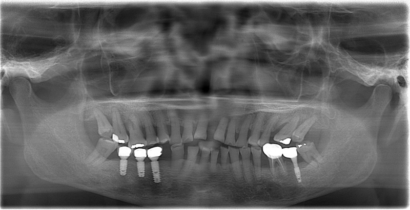嚴重牙周病治療前的環口式X光片