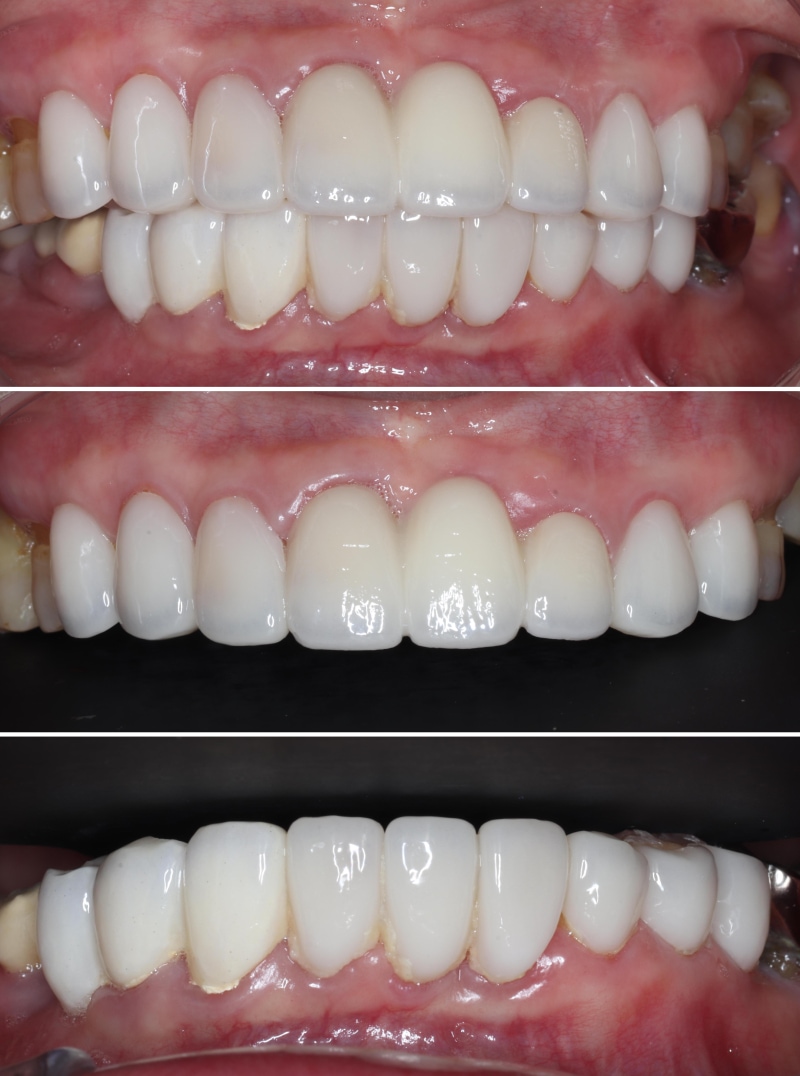 牙周治療與美容重建後的上下顎口內照，顯示牙齒排列自然且咬合穩定