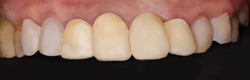 上顎前牙區臨時假牙與複合樹脂試戴，顯示牙齒初步外型溝通狀態