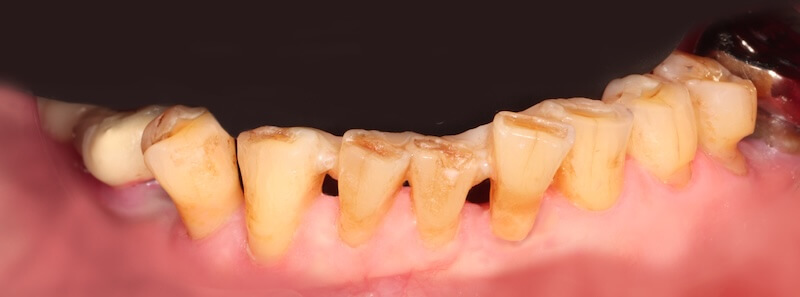 下顎前牙以Ribbond進行齒間固定，穩定鬆動牙齒並預防位置持續偏移(側)