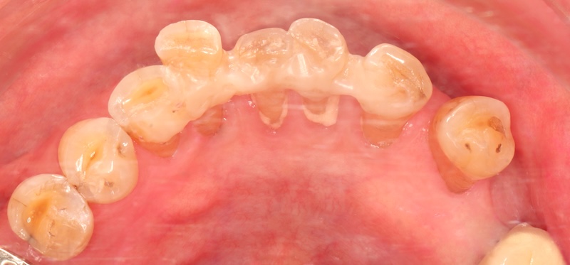 下顎前牙以Ribbond進行齒間固定，穩定鬆動牙齒並預防位置持續偏移(上)