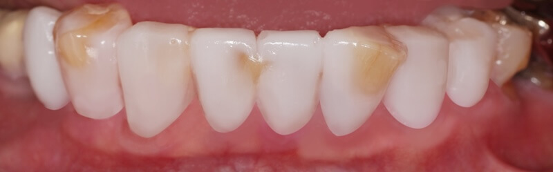 下顎前牙區進行樹脂試戴，顯示牙齒原始位置較突出，顏色較深之處需較多修磨量