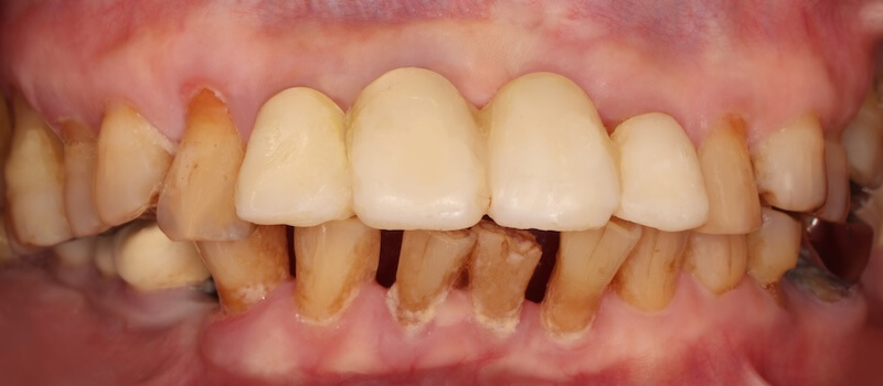 牙周治療前已拔除左上正門牙，並製作臨時假牙維持美觀與功能