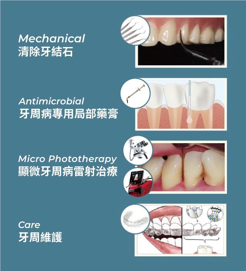 MAPCare牙周病專科治療方案