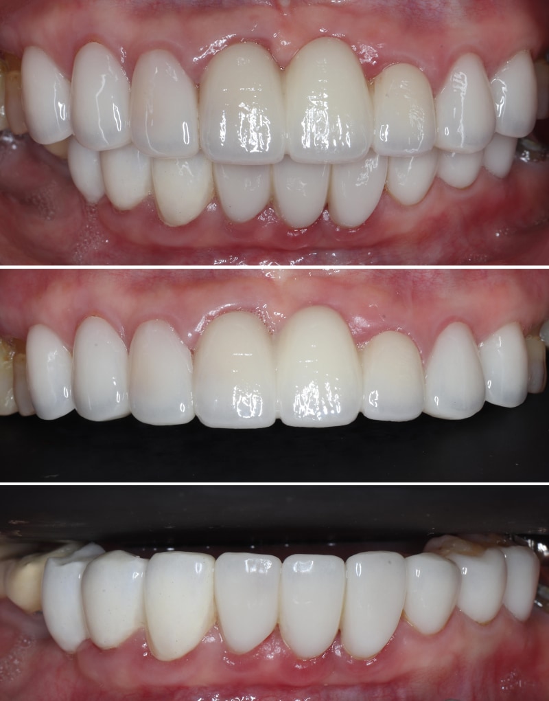 牙周治療與美容重建後的上下顎口內照，顯示牙齒排列自然且咬合穩定