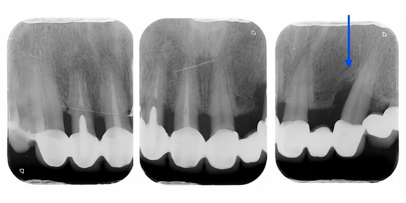 牙周病治療案例-前牙假牙拆除前局部牙齒根尖X光片
