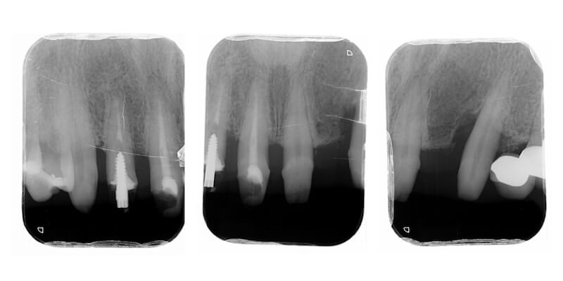 牙周病治療案例-前牙假牙拆除後局部牙齒根尖X光片