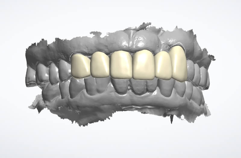 牙周病治療案例-口內掃描檔案供牙技師進行臨時假牙設計
