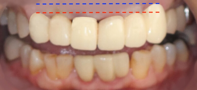 牙周病治療案例-左上犬齒的牙齦線較高影響視覺協調
