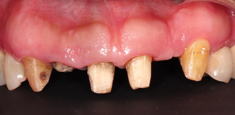 牙周病治療案例-拆除舊假牙後記錄照