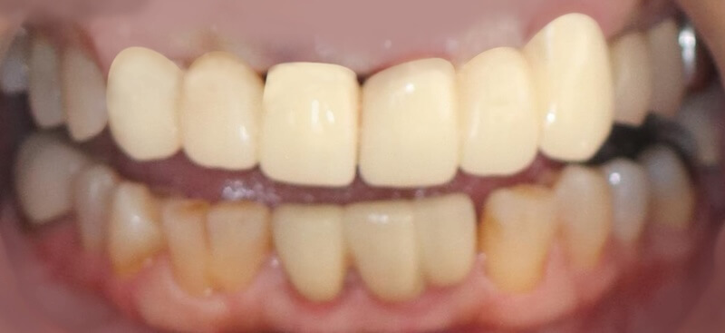 牙周病治療案例-新臨時假牙供實地配戴