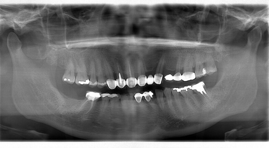 高血壓患者牙周病治療推薦：顯微水雷射牙周治療/DSD數位微笑設計
