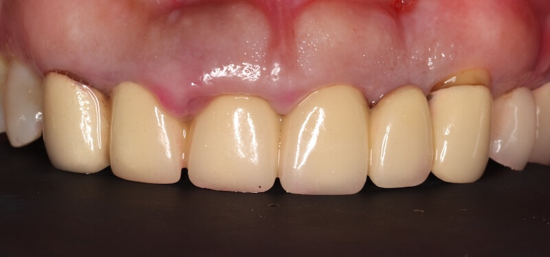 牙周病治療案例-治療前後比較-治療前