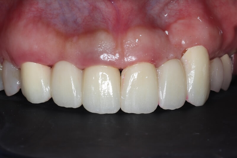 牙周病治療案例-治療前後比較-治療後