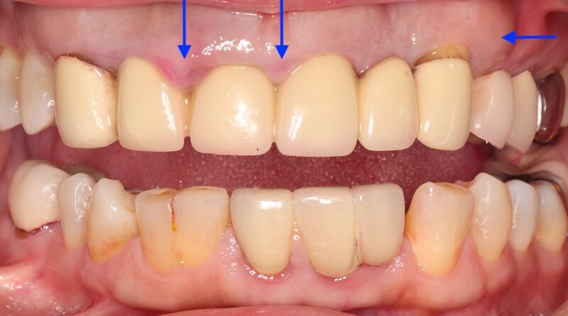 牙周病治療案例-治療前有明顯牙齦腫大現象