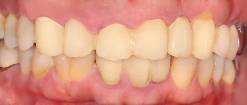 牙周病治療案例-治療前臨時假牙與牙齦紀錄照