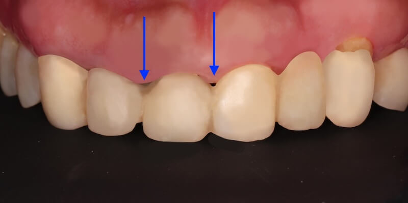 牙周病治療案例-治療後臨時假牙與牙齦間出現縫隙