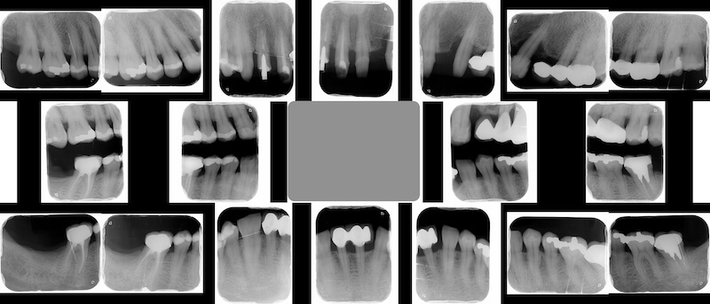 牙周病治療案例-治療牙周前口內全口X光片