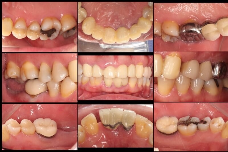 牙周病治療案例-治療牙周前口內紀錄照