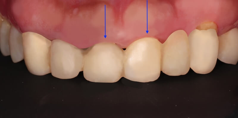 牙周病治療案例-配戴臨時假牙可看出門牙牙齦線不等高