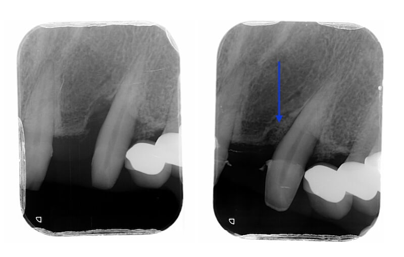牙周病治療案例-顯微牙周再生手術前後X光片比較