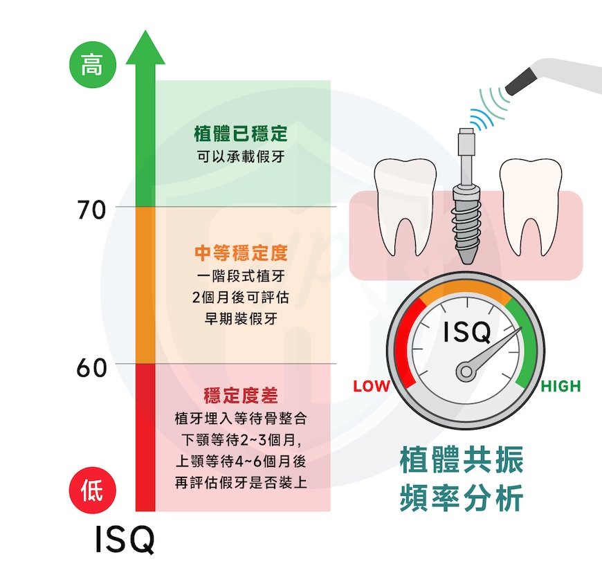 植體穩定度測量儀器 ISQ 測量示意圖
