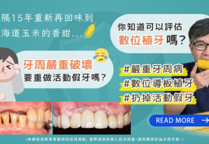 長輩植牙治療推薦: 活動假牙換植牙/數位植牙