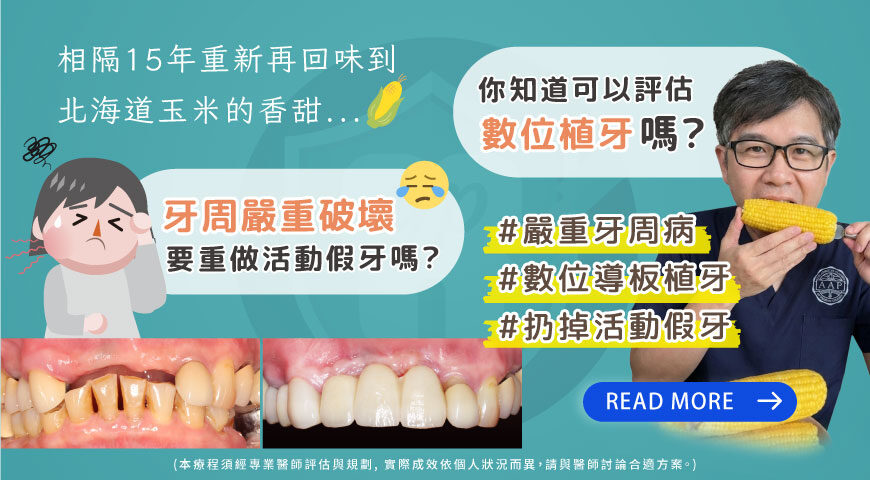 長輩植牙治療推薦: 活動假牙換植牙/數位植牙